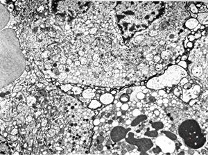 F, 59y. | pituitary adenoma (ACTH) … Crooke cell